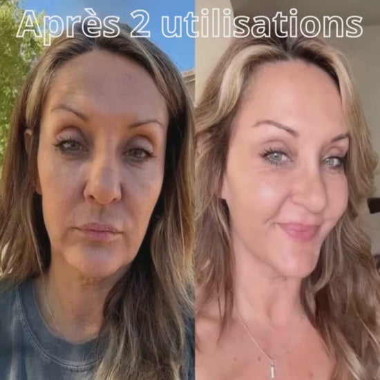 NevaFusion™ - Micro infusion invisible, résultats visibles